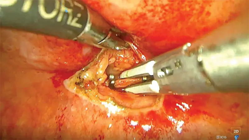 Minimally invasive surgery techniques improve idiopathic chylothorax treatments