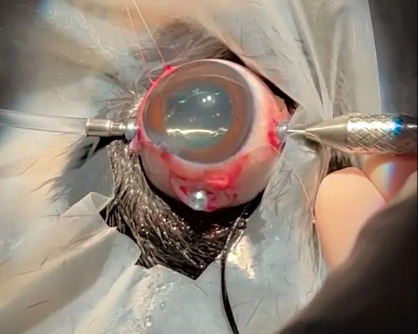 Spotlight on vitreoretinal surgery